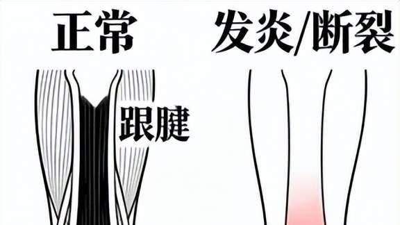 沙星类药物与肌腱炎——不可不知的几件事
