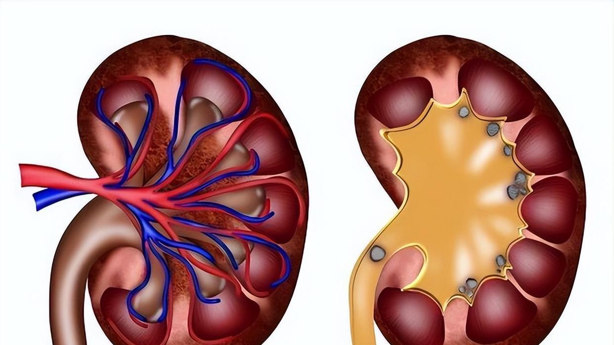 查出肾囊肿，吃金匮肾气丸为什么没用？你忘记配上这个古方了
