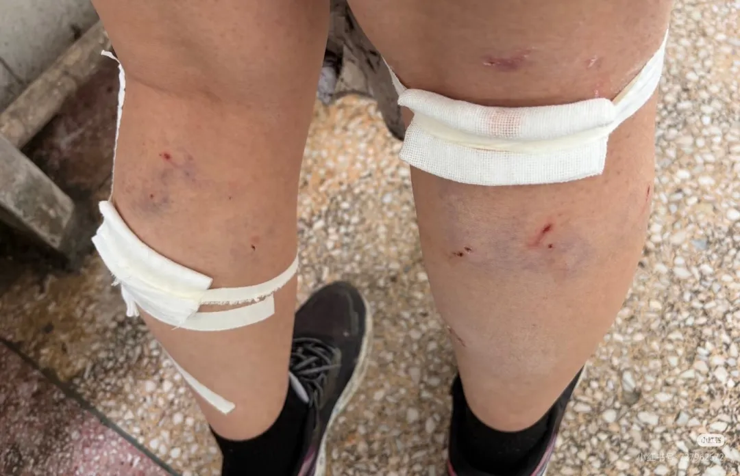 平顶山学院学生夜归遭流浪狗围攻致 Ⅲ 级咬伤 校方曾明令禁犬却仍存隐患