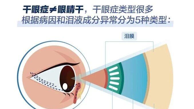 干眼症不是小毛病！拖到重度可能要角膜移植，附自测+急救指南