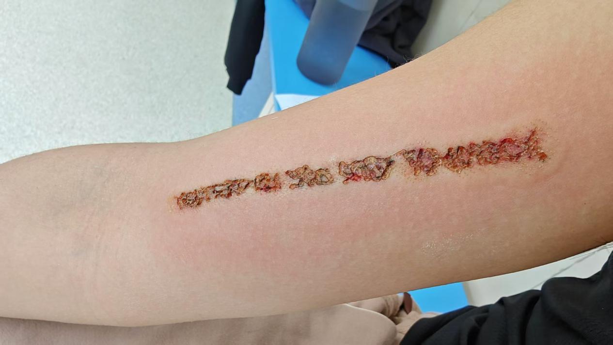 贵州一青年洗纹身致伤残 母亲维权8个月盼中立调解