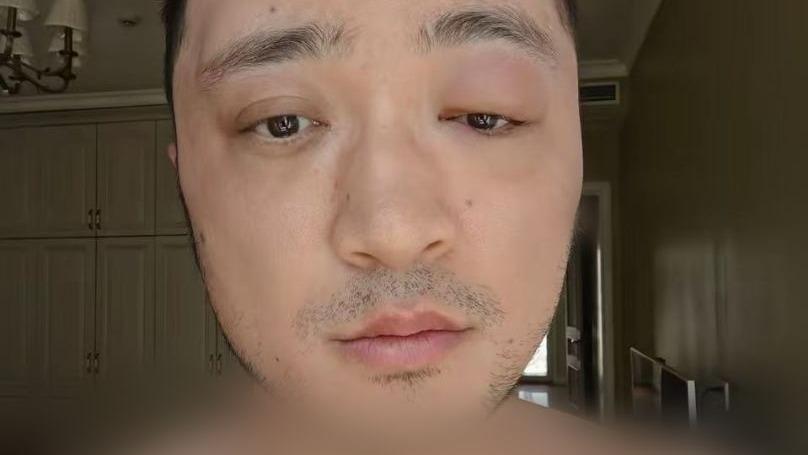 尼格买提因发眼肿照片上热搜，网友以为被打了，结果图片秒删