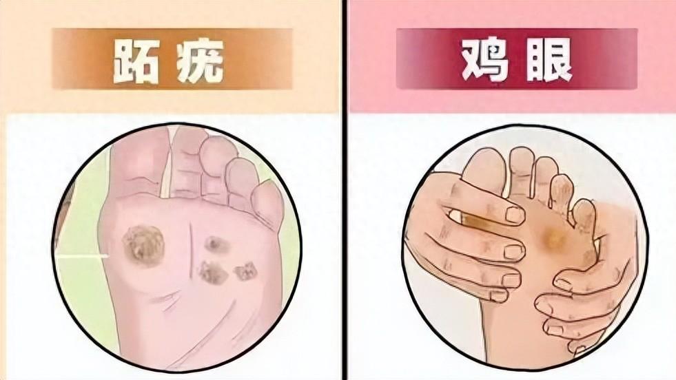 磨出来的鸡眼，感染来的跖疣，选对治疗方法才管用！