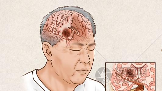 警惕！这5个日常习惯，正在悄悄堵塞你的血管