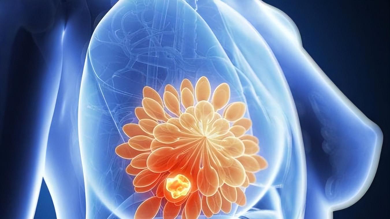 体检查出乳腺结节？别慌也别乱养！9成是良性，最怕你做错3件事