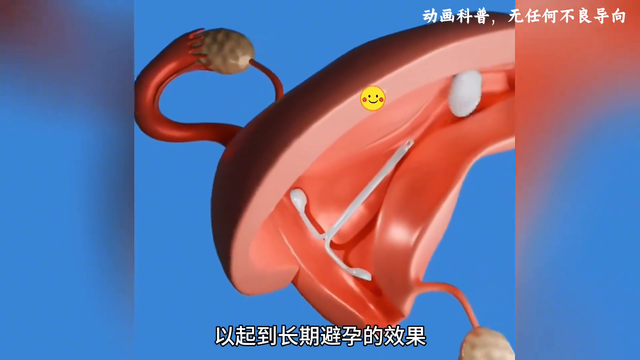 四种完全不同的避孕方式，你一共知道几种呢