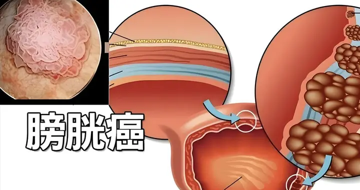 膀胱有癌，尿液先知？小便时，若总是出现3种异常，查一下膀胱！