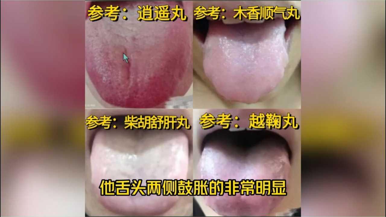 武楠主任舌象分析案例：第四期