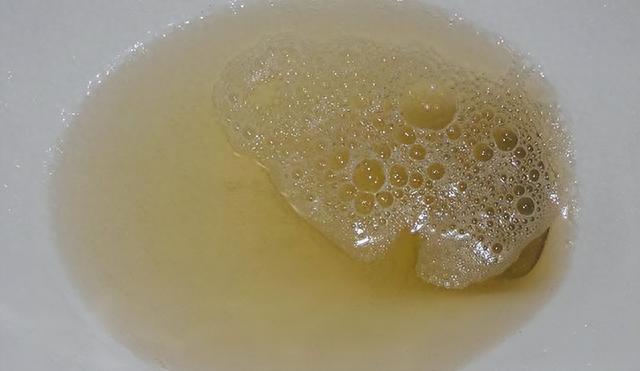 小便经常发黄，未必是上火！可能是这三个原因，教你一方退黄！