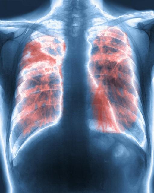 为什么风湿病会引发肺纤维化