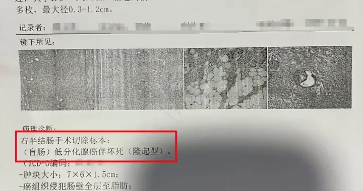 68岁结肠术后，低分化腺癌，pT4bN0Mx——病理报告解读