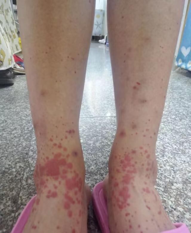 维生素B|过敏性紫癜怎么提高免疫力？