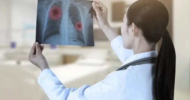 早期肺癌30%~55%会复发转移，专家提醒：这2件事不能省