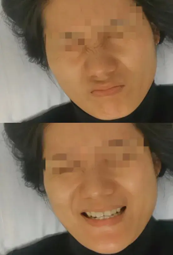 针药并用治“面瘫”