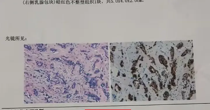 40岁两阳一阴浸润性乳腺癌，见微转移——病理报告解读