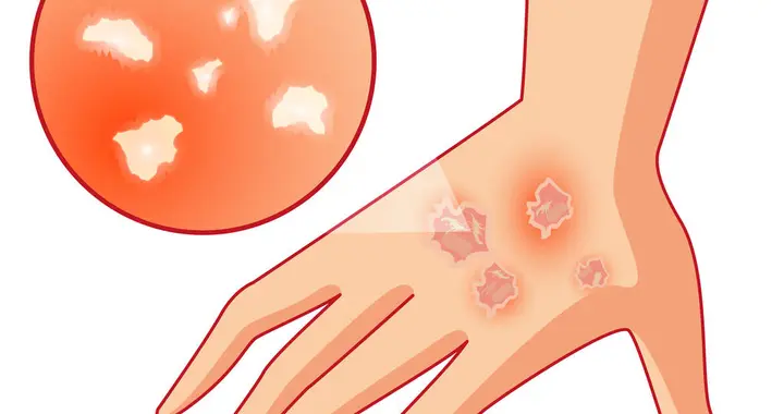 身上"风团"来去如风，你以为忍忍就好？医生：这些情况必须就医