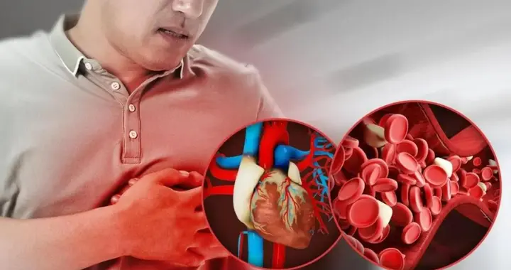 血脂胆固醇下降50%？《柳叶刀》揭晓新型降脂疗法，3亿人群迎福音