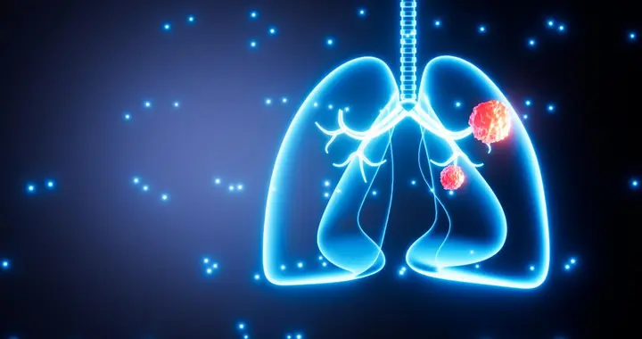 医生研究发现：人患肺癌前1年，身体一般会出现3个预警信号