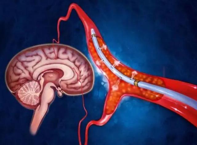 为何越来越多的农村人得了“脑梗”？医生：原因有三，麻烦了解下