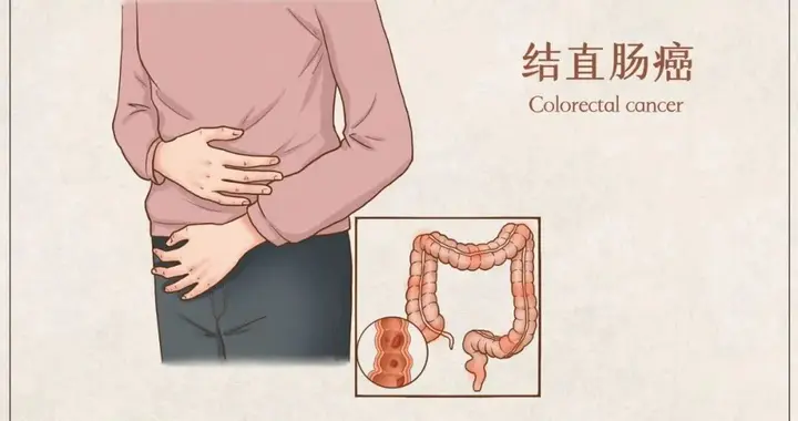 抗结直肠癌细胞制剂——靶向干预结直肠癌，预防复发转移