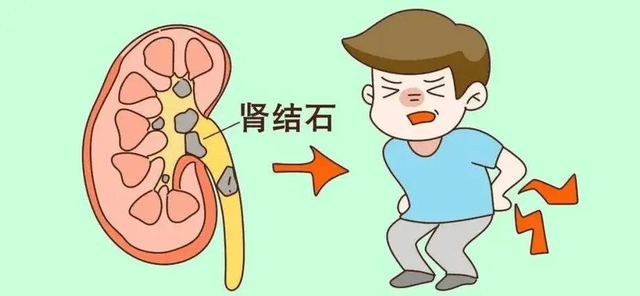 多大的肾结石可以排出来？体外碎石想做就做？看完就明白了