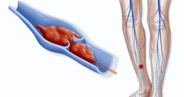 体检发现肌间静脉血栓，是“警报”还是“虚惊一场”？