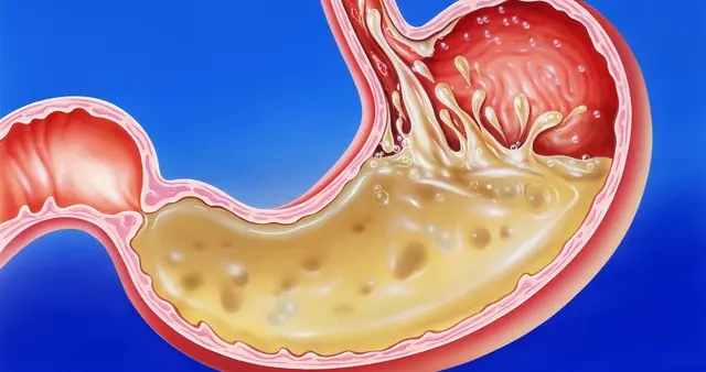 萎缩性胃炎到肠化生，离胃癌有多远？宋金玲主任揭秘