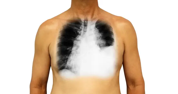 烟友最想知道的关于吸烟与肺癌的四小问！