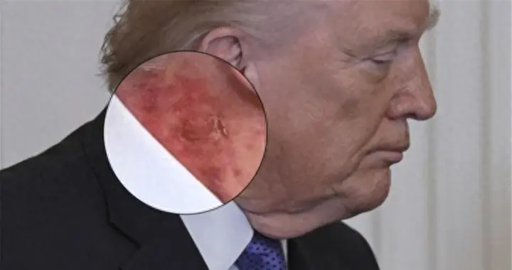 伊朗第18波报复，特朗普报应来了，得红脖子病，被逼从亚洲搬救兵