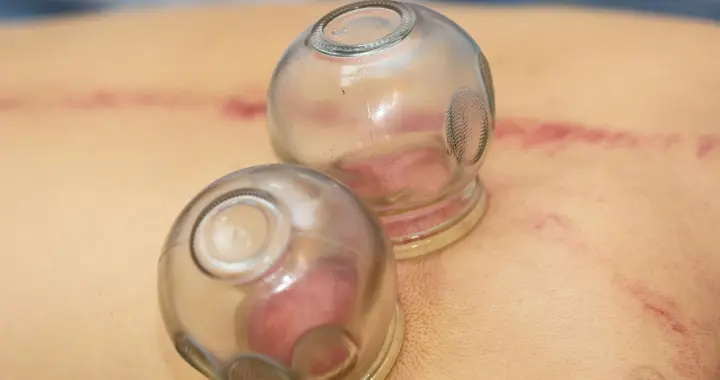 连拔两天火罐致高位截瘫，这些“养生雷区”你踩了吗？