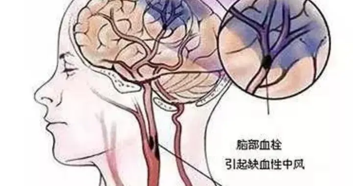 耳朵是脑梗的“放大镜”？医生提醒：耳朵若有这3症状，尽早就医