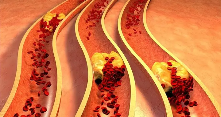自2026年起，体检发现颈动脉斑块的患者，千万重视做好这5项准备