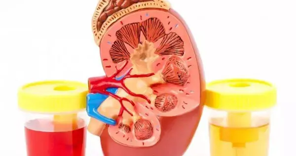 眼皮浮肿慢性肾炎怎么治疗？