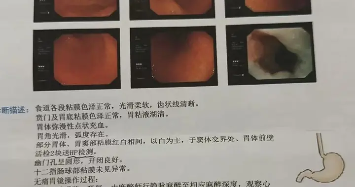 宋金玲主任：得了萎缩性胃炎别慌张！养胃记住“三板斧”