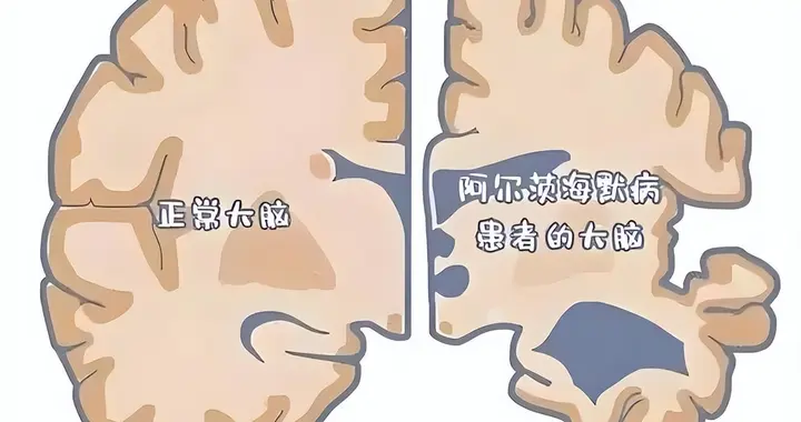 年轻化阿尔茨海默是如何触发的？