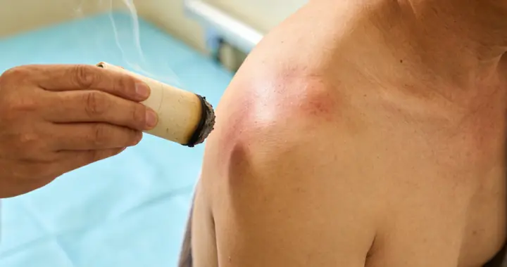 肩周炎胳膊抬不高，别再盲目拉伸，中医艾灸活血舒缓粘连