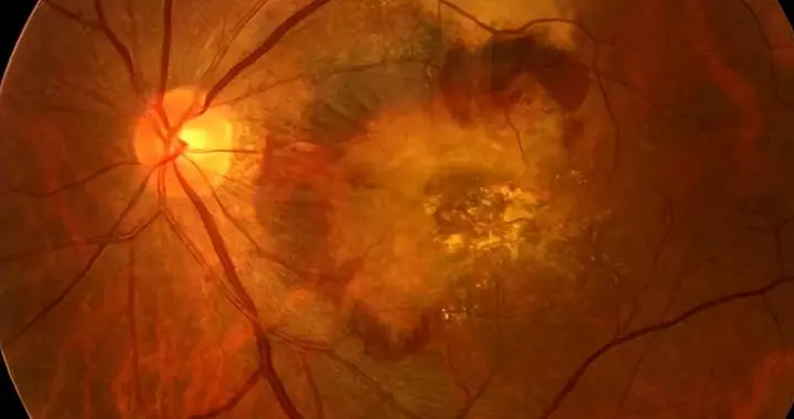 肠菌移植：糖尿病视网膜病变的“眼底守护者”！临床研究效果好