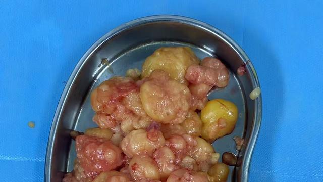 憨蹦大咚：脂肪瘤能不做最好还是不做，只要