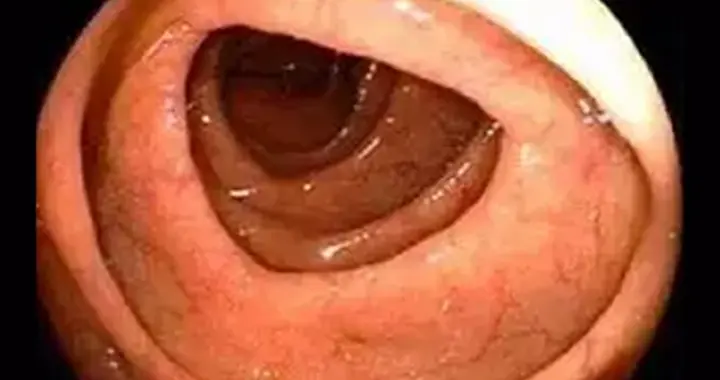 胃镜检查肠化什么意思？