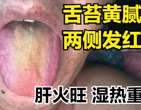 肝郁拖的时间太久了，最少4年起步，吃柴胡疏肝丸已经不行了！