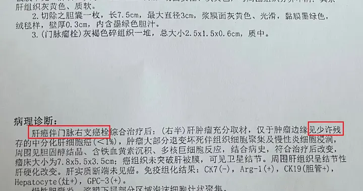 55岁肝细胞癌，未转移——病理报告解读