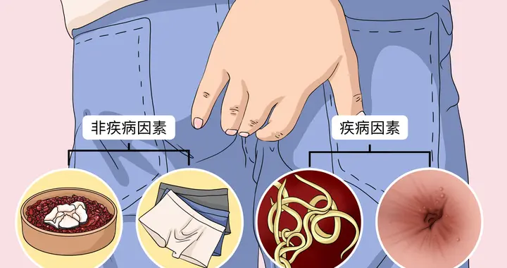 痔疮手术后，为什么肛门会瘙痒？详解原因与应对之道