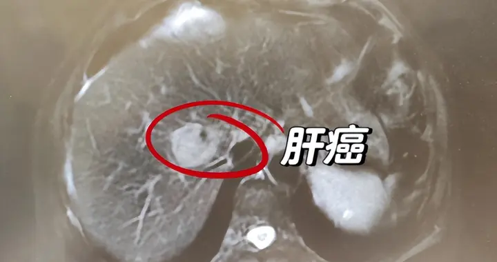 单发性肝癌和多发性肝癌，哪个更难治？听听郭医生怎么说？