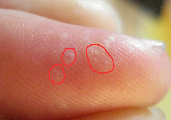 【健康】奇痒无比！一到夏天手指就长“小水泡”！到底该怎么应对？