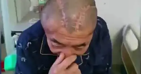 患者右脑出血被开左脑 当地回应