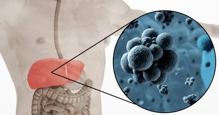 肝癌术后5个月就转移复发，这9个特征中招越多越危险！