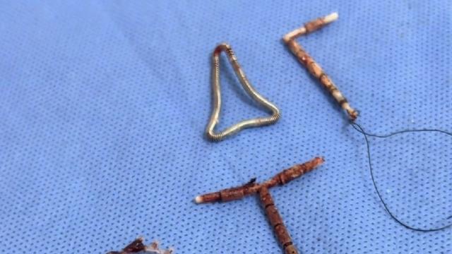 顺道：看了一个医生从妇女体内取出的4种环