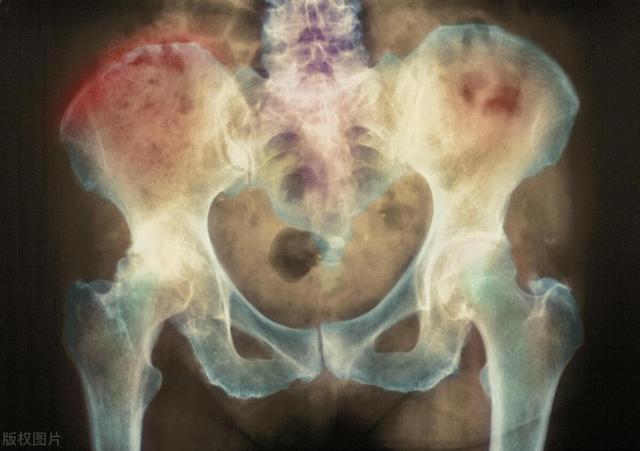 就在今日，若股骨头坏死，置换后就没事了吗？