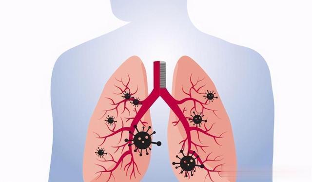 大蒜|大蒜是肺结节的“发物”？提醒：若想消散结节，这2物要少吃