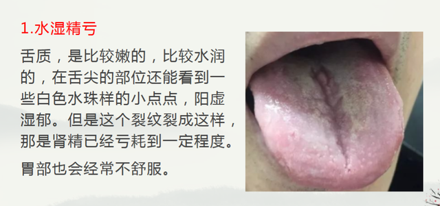 舌头有裂纹，说明体内有毛病！5种常见裂纹舌，今天一次讲解清楚